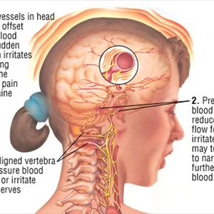 What Is A Complex Migraine - What Do We Mean By A Migraine Headache?