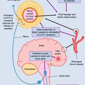 Sudden Severe Headache - Cluster Headache Treatment - Different Options For Cluster Headache Relief