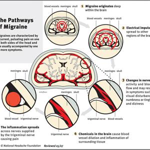 Migraine Headaches Treatment - Migraine